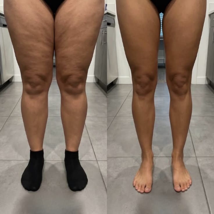 Antes y después: apariencia de celulitis en las piernas