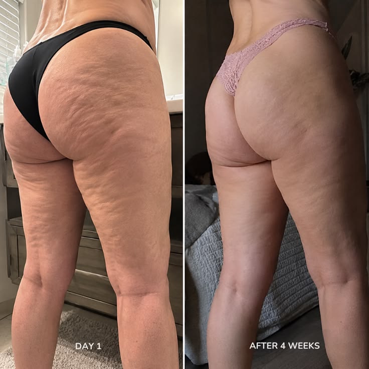 Antes y después: apariencia de celulitis tras 4 semanas